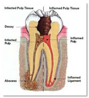 Impacted tooth